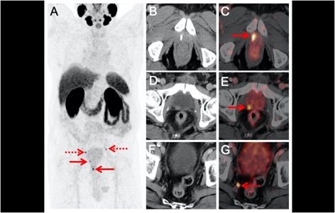 An Innovative Approach to Prostate Cancer Imaging