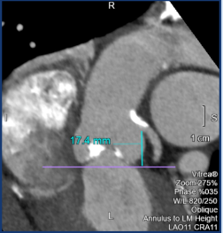 ECG Gated CT of Transcatheter Aortic Valve Replacement (TAVR) Planning