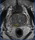 Multi-parametric Prostate MRI