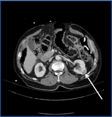 Cryoablation for Renal Cell Carcinoma (RCC)